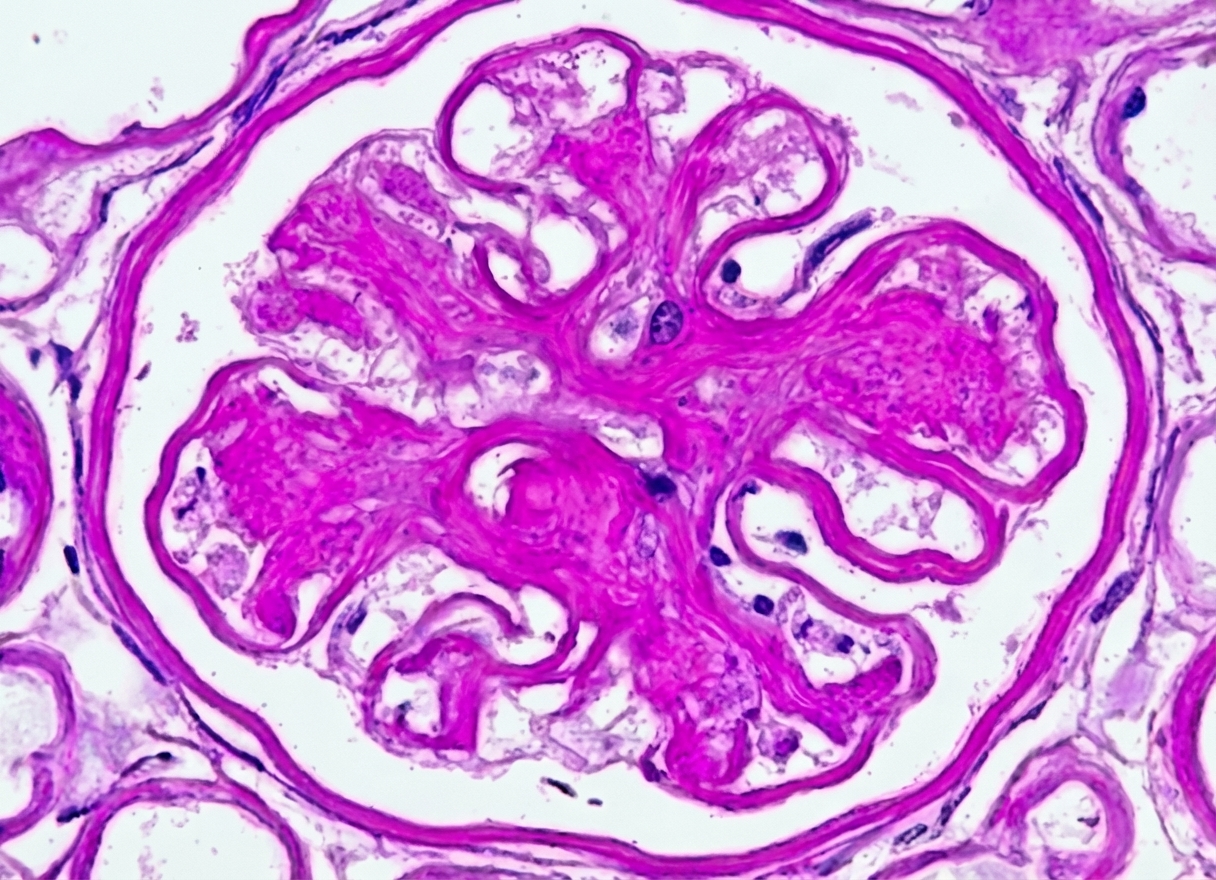 STZ-Induced Diabetic Nephropathy